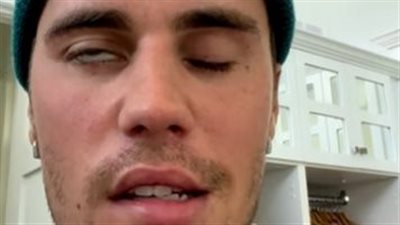 استشاري الأمراض الجلدية يكشف عن علاقة الحزام الناري بلقاحات كورونا 