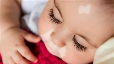 أستاذ جلدية: مرض البهاق قد يصيب الأطفال لأسباب نفسية (فيديو)