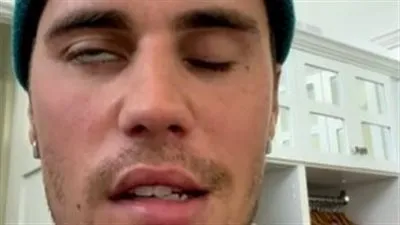 جاستن بيبر يؤجل جولته المتبقية بأمريكا الشمالية بعد إصابته بشلل في وجهه