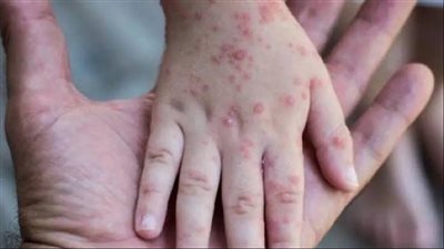 بعد إعلان حالة الطوارئ.. معلومات هامة عن جدري القرود وحقيقة ظهوره بمصر