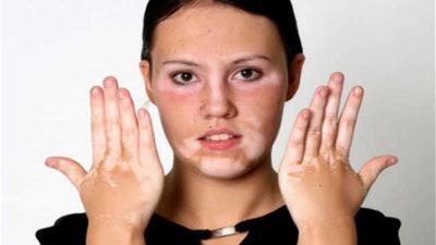 مرض البهاق.. التفاصيل الكاملة حول أسبابه وأعراضه وطرق علاجه