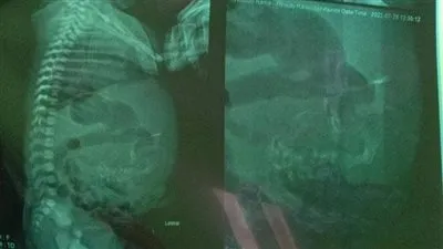 طبيب يكشف تفاصيل اكتشاف حالة طفلة تحمل بداخلها جنينا بالدقهلية (فيديو)