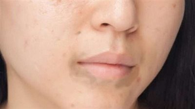 هاني الناظر يكشف أسباب وعلاج الإسمرار حول الفم (فيديو)