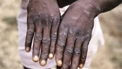 غواتيمالا تعلن تسجيل أول إصابة بجدري القردة 