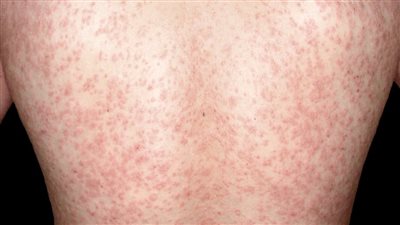 هاني الناظر يوضح أعراض وطرق علاج النخالة الوردية (فيديو)