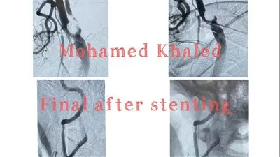 الصحة: الهرم التخصصي تنجح في اجراء حالتين قسطرة مخية علاجية 