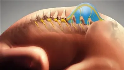 ما هو مرض الصلب المشقوق؟.. ننشر الأسباب وأنواعه