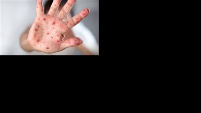 بعد إصابة أول مصري.. ما لا تعرفه عن جدري القرود