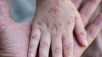 خبير علم أوبئة يكشف أكثر عرض مميز للإصابة بـ 