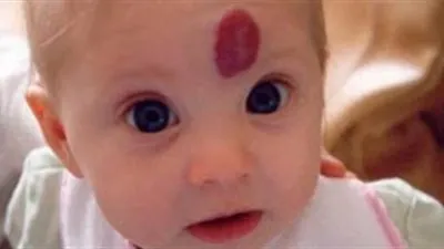 الوحمة الدموية.. أنواعها واسباب ظهورها وطرق علاجها