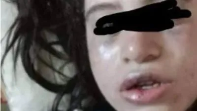 أب وزوجته يعتدون بالضرب المبرح والحرق لطفلين للزوجة الأولى ببورسعيد