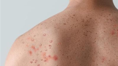 مستشار الرئيس للصحة يكشف إجمالي المصابين بجدري القرود في مصر (فيديو)