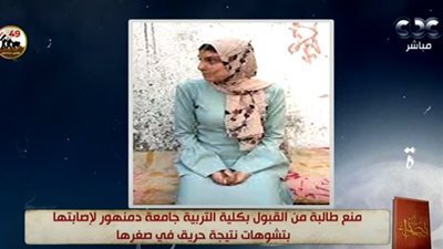 مواجهة بين رئيس جامعة دمنهور وطالبة مرفوضة بسبب تشوهات حريق