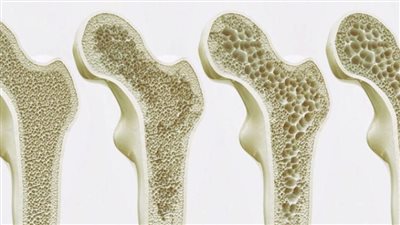 في اليوم العالمي لهشاشة العظام.. تعرف على أبرز الأسباب وطرق العلاج
