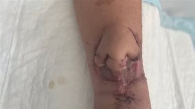 بعد معاناة مع السرطان.. زراعة أنف على ذراع فتاة فرنسية