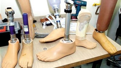 كيفية التعايش مع الأطراف الصناعية جسديا ونفسيا