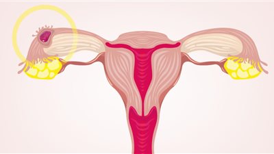 الحمل خارج الرحم.. تعرف على أعراضه وطرق علاجه