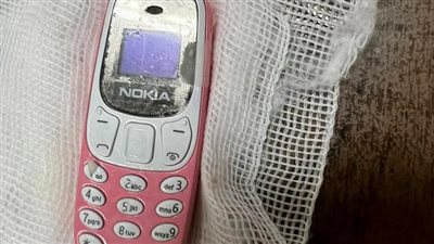 فريق طبي ينجح في استخراج هاتف محمول من معدة شاب في الغربية (صور)