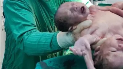 نجاح فصل توأم ملتصق بمستشفى جامعة المنصورة (صور)