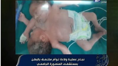 مدير مستشفى المنصورة الجامعي يكشف تفاصيل الولادة النادرة لتوأم ملتصق (فيديو)