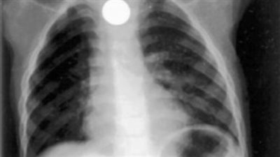 صحة السويس تكشف تفاصيل انقاذ طفل 3 سنوات ابتلع عملة معدنية (فيديو)