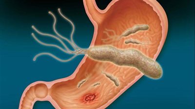 الجرثومة الحلزونية.. أسباب الإصابة وطرق العلاج وعلاقتها بالسرطان (فيديو)