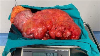 استئصال ورم وزنه 8 كجم من معدة مريض في المنصورة