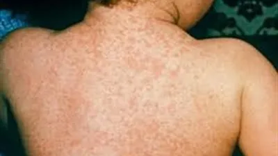 ما لا تعرفه عن الحمى الشوكية وأعراضها؟