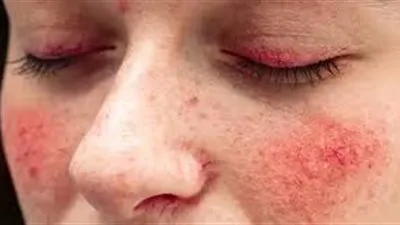 بعد إصابة سيلينا جوميز.. ما لا تعرفه عن مرض الذئبة الحمراء؟