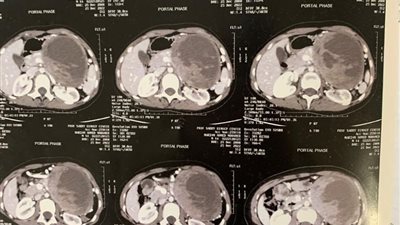 استئصال ورم سرطانى متكيس بالبنكرياس من طفلة تعاني من المرض في جامعة المنصورة 