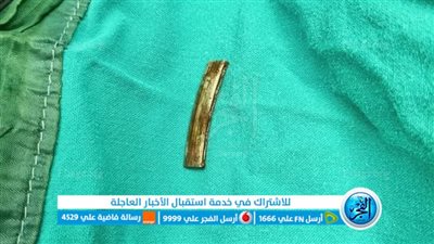 أطباء مستشفى الباجور ينجحون في استخراج جسم معدني من الأحبال الصوتية لمسن بالمنوفية