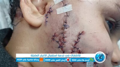 كلب يعقر طفلا في وجهه بالمنوفية.. 