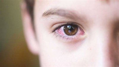 أعراض الرمد الربيعي لدى الأطفال (تفاصيل)