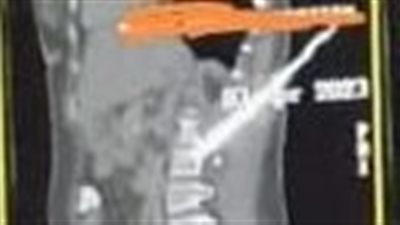 طوارئ قصر العينى تسجل إنجازا طبيا جديدا بجراحة خطرة استغرقت 3 ساعات