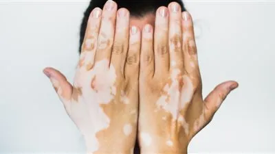 كل ما تريد معرفته عن مرض البهاق