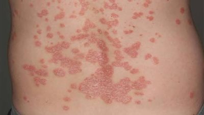 مرض الصدفية.. ما أعراضة وأنواعه وعلاجه؟