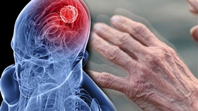 مرض باركنسون.. تعرف عليه وما يؤثر على الجهاز العصبي