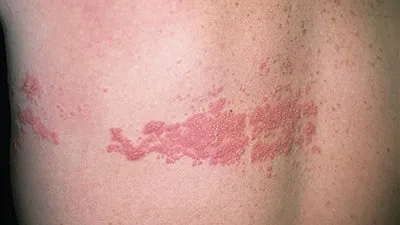 كل ما تريد معرفته عن مرض الحزام الناري.. يسببه فيروس معروف