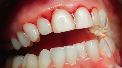 نزيف اللثة.. الأسباب والأعراض وطرق الوقاية