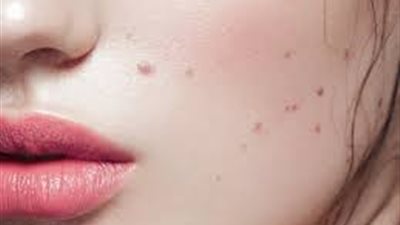 كيف تتخلصين من الشامات دون جراحة؟