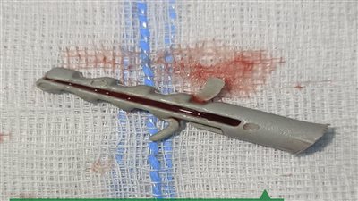 طفل في قنا يستنشق فيشر مسمار وفريق طبي ينجح في إنقاذه