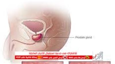 أعراض الإصابة بمرض سرطان البروستاتا وطرق العلاج