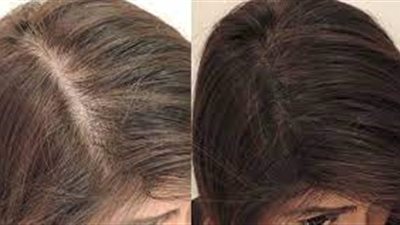 فراغات الشعر.. من الأسباب للعلاج بطرق طبيعية تعرفي