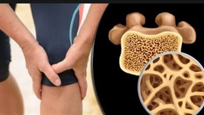 في يومه العالمي.. كل ما تريد معرفته عن مرض هشاشة العظام