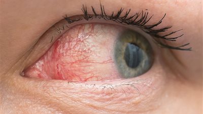 4 علاجات المنزلية لجفاف العين