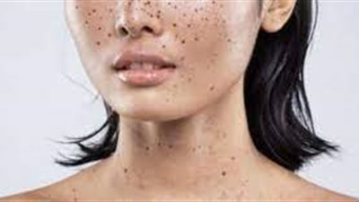 تخلصي من النمش نهائيًا بالأعشاب.. تعرفي 