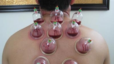 ما هي الحجامة وما أنواعها؟