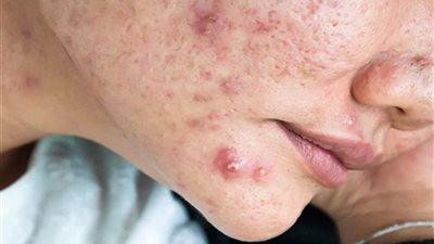 تعرف على فوائد العسل لعلاج حب الشباب