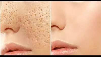 تسكير مسامات الوجه.. نصائح فعّالة للحفاظ على بشرة خالية من المسامات الواسعة