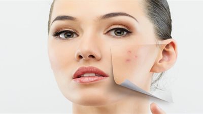 8 نصائح لتقليل آثار الحبوب بالبشرة والتخلص منها